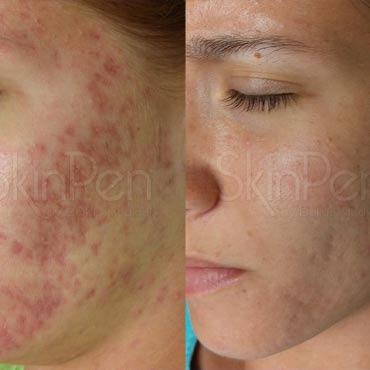 skin before and after skinpen treatment