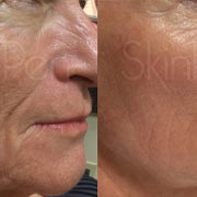 Skinpen before and after, anit-ageing
