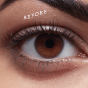 Before SVS treatment