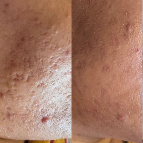 DÉCAAR peel result image