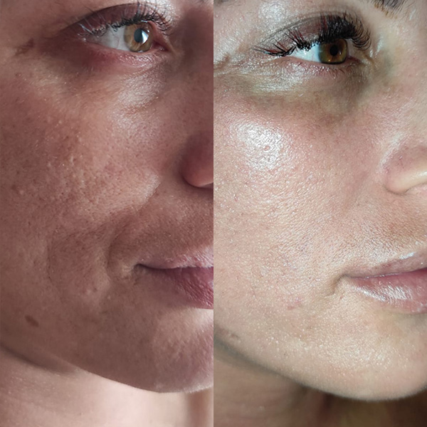 DÉCAAR peel result close-up