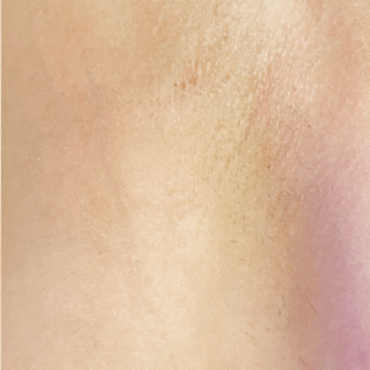 After 3D Hydro2 Facial